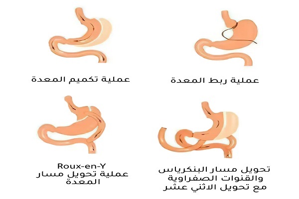 جراحات السمنة وتدبيس المعدة